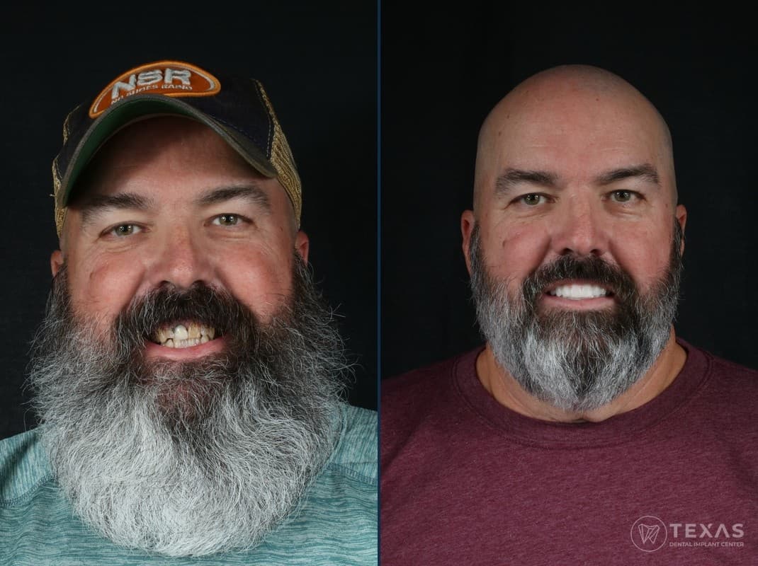 Before and after dental implant results - Patient 12 at Texas Dental Implant Center Houston