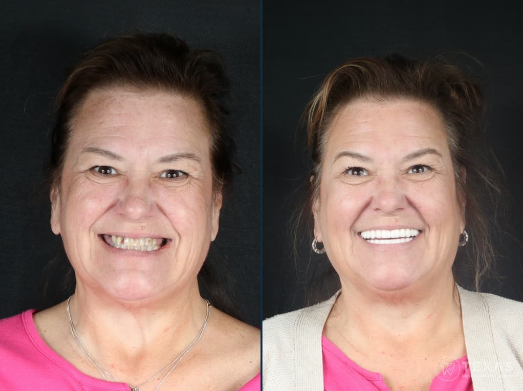 Before and after dental implant results - Patient 14 at Texas Dental Implant Center Houston