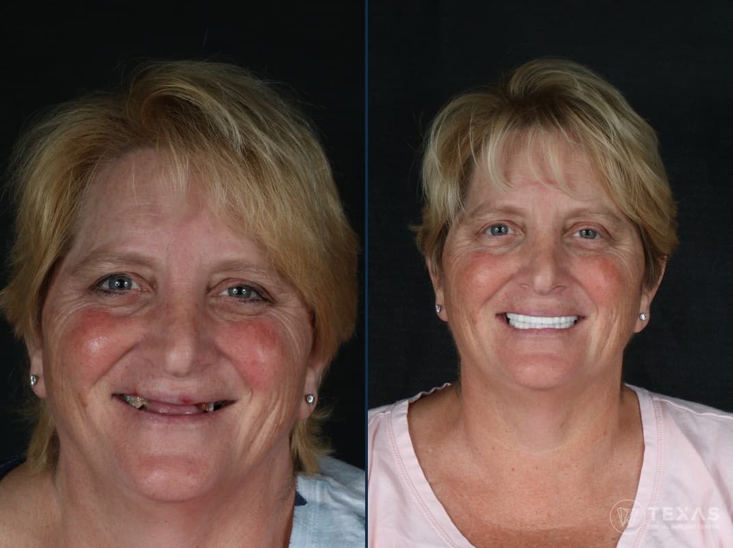 Before and after dental implant results - Patient 17 at Texas Dental Implant Center Houston