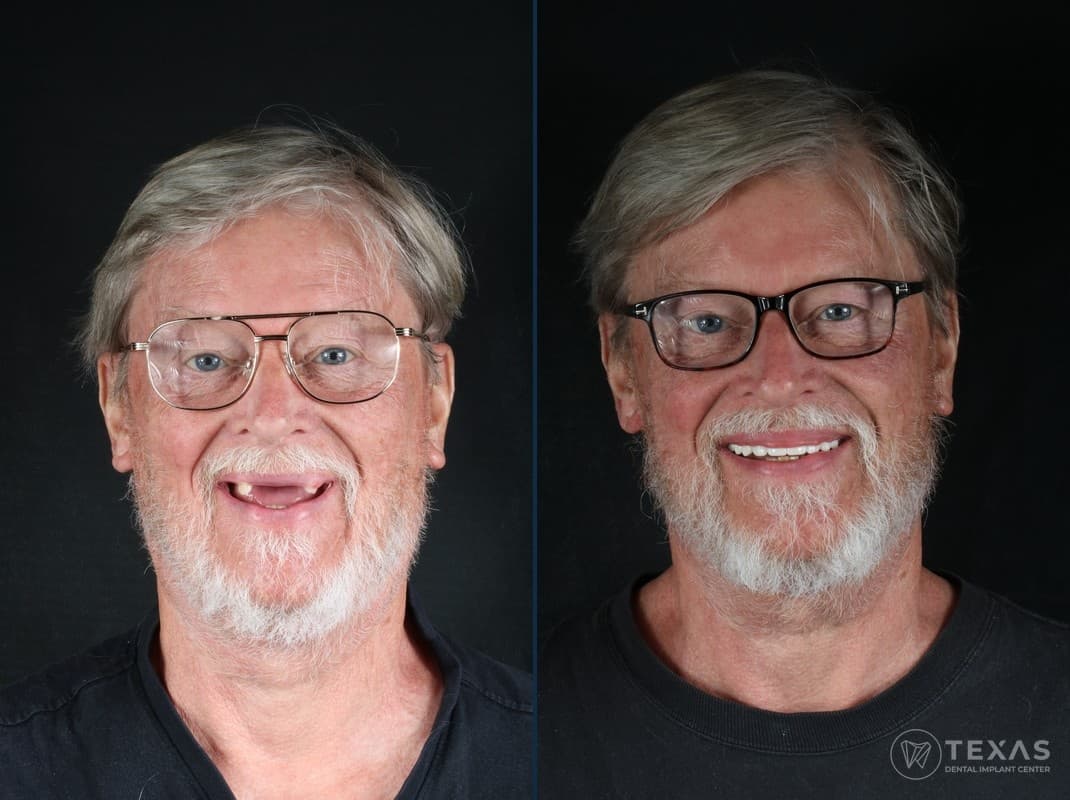 Before and after dental implant results - Patient 3 at Texas Dental Implant Center Houston