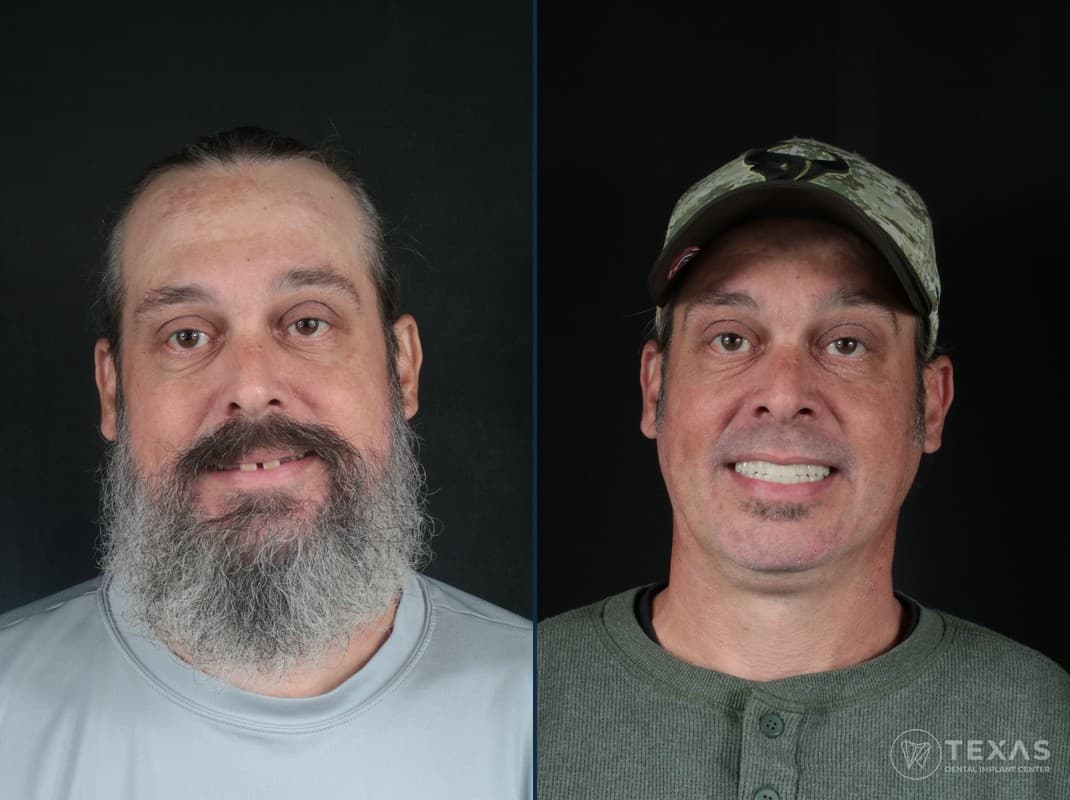 Before and after dental implant results - Patient 4 at Texas Dental Implant Center Houston