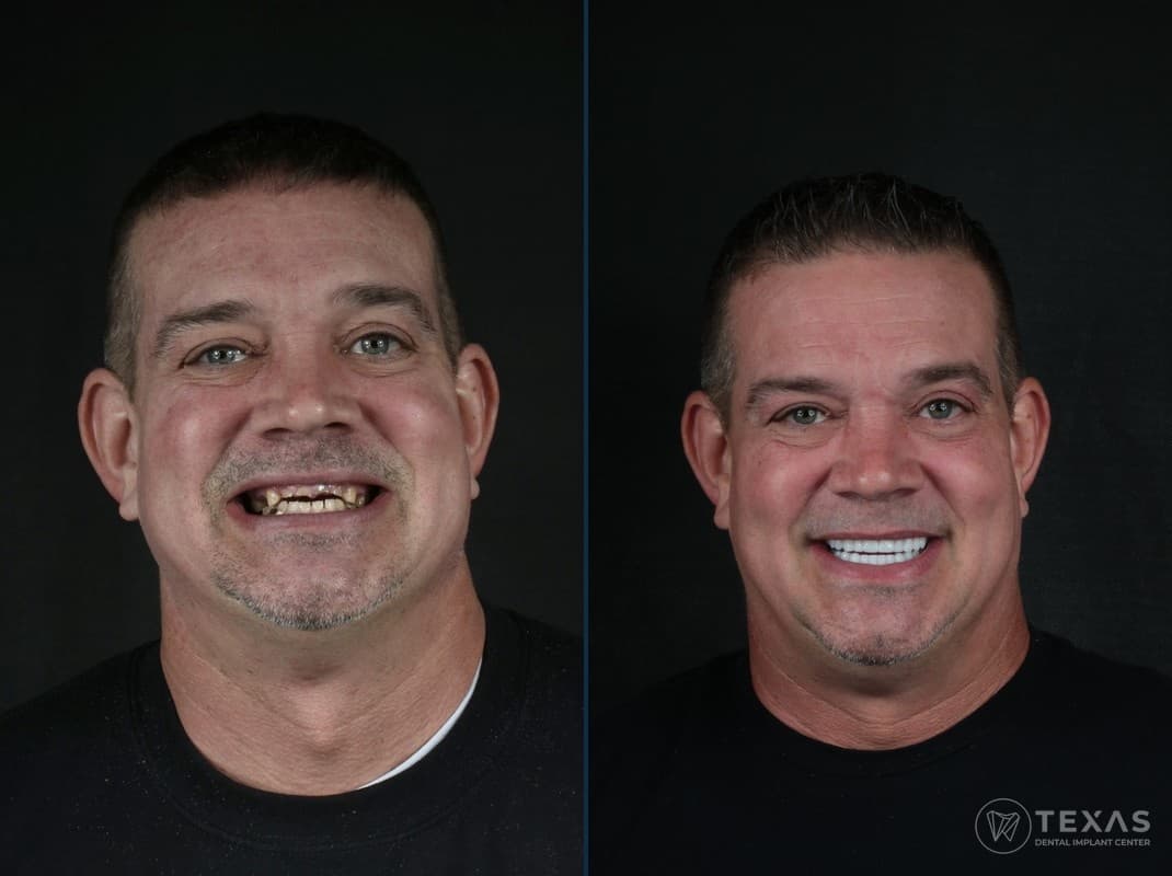 Before and after dental implant results - Patient 7 at Texas Dental Implant Center Houston