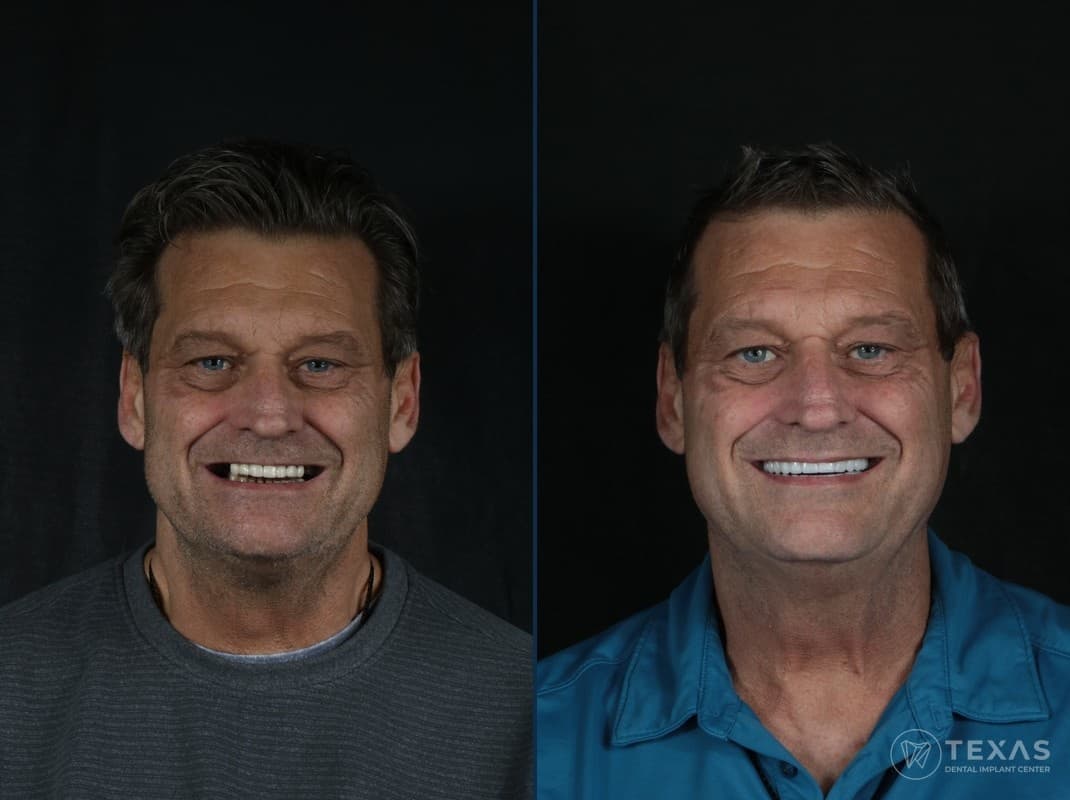Before and after dental implant results - Patient 8 at Texas Dental Implant Center Houston
