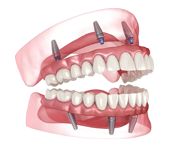 3D illustration of All-on-X fixed full arch dental implants